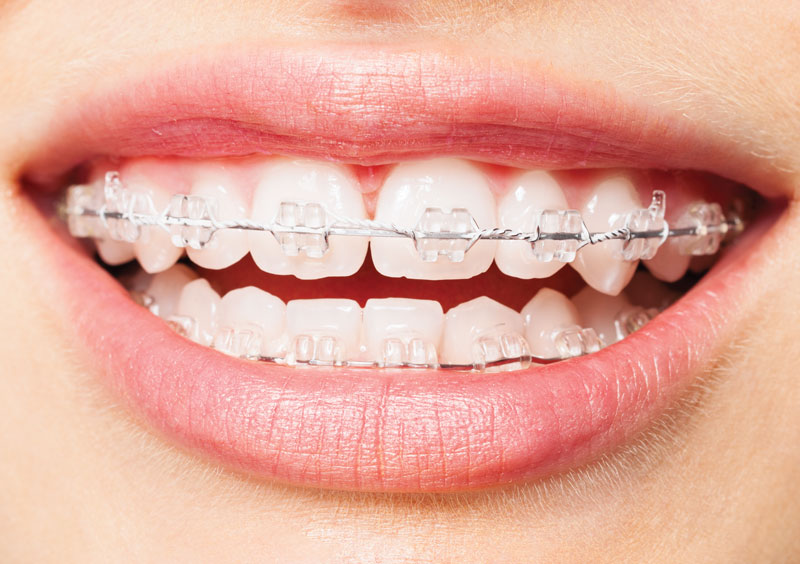 Gyerek fogszabályozás Esztergom - Crown Dental